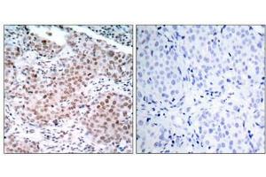 Immunohistochemical analysis of paraffin-embedded human breast carcinoma tissue using Estrogen Receptor-a(Phospho-Ser104) Antibody(left) or the same antibody preincubated with blocking peptide(right). (Estrogen Receptor alpha anticorps  (pSer104))