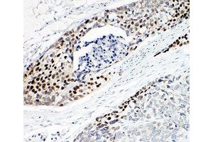 IHC-P: p63 antibody testing of human esophageal squamous cell carcinoma tissue (TCP1 alpha/CCTA anticorps  (AA 82-98))
