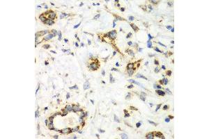 Immunohistochemistry of paraffin-embedded human liver cancer using NRBF2 antibody at dilution of 1:100 (x40 lens). (NRBF2 anticorps)
