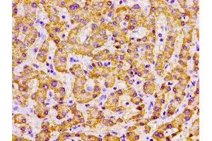 Immunohistochemistry of paraffin-embedded human liver cancer using ABIN7142326 at dilution of 1:100