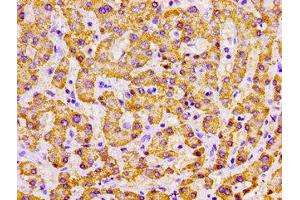 Immunohistochemistry of paraffin-embedded human liver cancer using ABIN7142326 at dilution of 1:100 (MPST anticorps  (AA 102-208))