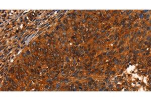 Immunohistochemistry of paraffin-embedded Human cervical cancer using PRKD1 Polyclonal Antibody at dilution of 1:40