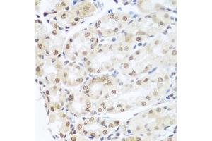 Immunohistochemistry of paraffin-embedded human gastric cancer using SNAI1 antibody. (SNAIL anticorps)