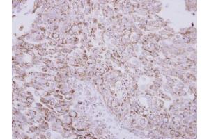 IHC-P Image Immunohistochemical analysis of paraffin-embedded human breast cancer, using Protein C, antibody at 1:250 dilution. (PROC anticorps)