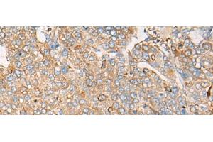 Immunohistochemistry of paraffin-embedded Human liver cancer tissue using CAPN9 Polyclonal Antibody at dilution of 1:45(x200) (Calpain 9 anticorps)