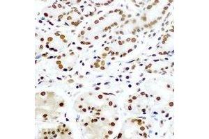 Immunohistochemical analysis of Pontin 52 staining in human gastric cancer formalin fixed paraffin embedded tissue section. (RUVBL1 anticorps)