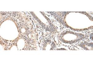 Immunohistochemistry of paraffin-embedded Human gastric cancer tissue using ZNF281 Polyclonal Antibody at dilution of 1:30(x200) (ZNF281 anticorps)