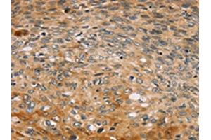 The image on the left is immunohistochemistry of paraffin-embedded Human esophagus cancer tissue using ABIN7192739(TBC1D21 Antibody) at dilution 1/30, on the right is treated with synthetic peptide.