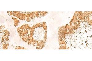 Immunohistochemistry of paraffin-embedded Human liver cancer tissue using POLR1D Polyclonal Antibody at dilution of 1:50(x200) (POLR1D anticorps)