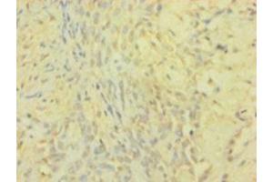 Immunohistochemistry of paraffin-embedded human breast cancer using TIMP1 Antibody at a dilution of 1:100.
