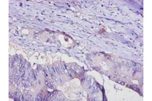 Immunohistochemistry of paraffin-embedded human colon cancer using ABIN7143414 at dilution of 1:100