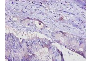 Immunohistochemistry of paraffin-embedded human colon cancer using ABIN7143414 at dilution of 1:100 (ADIPOQ anticorps  (AA 19-244))