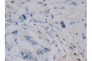 Detection of DEFa4 in Human Bile duct cancer Tissue using Polyclonal Antibody to Defensin Alpha 4, Corticostatin (DEFa4)