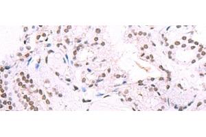 Immunohistochemistry of paraffin-embedded Human thyroid cancer tissue using IRF2BP1 Polyclonal Antibody at dilution of 1:40(x200) (IRF2BP1 anticorps)