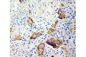 Anti-Bone Sialoprotein antibody, IHC(P) IHC(P): Human Osteosarcoma Tissue (IBSP anticorps  (N-Term))
