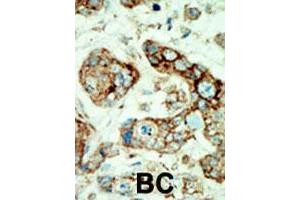 Formalin-fixed and paraffin-embedded human cancer tissue reacted with EPHA2 polyclonal antibody  , which was peroxidase-conjugated to the secondary antibody, followed by AEC staining. (EPH Receptor A2 anticorps  (N-Term))