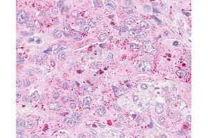 Anti-OXER1 antibody IHC of human Pancreas, Carcinoma.