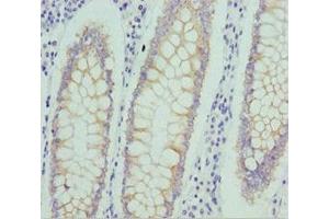 Immunohistochemistry of paraffin-embedded human colon cancer using ABIN7161746 at dilution of 1:100 (NUAK2 anticorps  (AA 479-628))