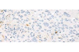 Immunohistochemistry of paraffin-embedded Human cervical cancer tissue using FABP4 Polyclonal Antibody at dilution of 1:60(x200)