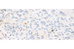 Immunohistochemistry of paraffin-embedded Human cervical cancer tissue using FABP4 Polyclonal Antibody at dilution of 1:60(x200) (FABP4 anticorps)