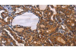 Immunohistochemistry of paraffin-embedded Human thyroid cancer using ILK Polyclonal Antibody at dilution of 1:50 (ILK anticorps)