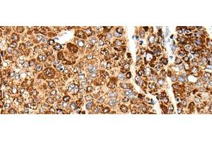 Immunohistochemistry of paraffin-embedded Human liver cancer tissue using CACNG5 Polyclonal Antibody at dilution of 1:50(x200) (CACNG5 anticorps)