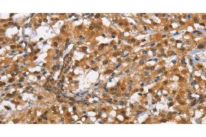 Immunohistochemistry of paraffin-embedded Human thyroid cancer tissue using CD13 Polyclonal Antibody at dilution 1:80 (CD13 anticorps)
