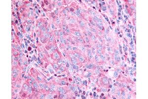 Anti-GPR45 antibody IHC of human Skin, Melanoma. (GPR45 anticorps  (Cytoplasmic Domain))