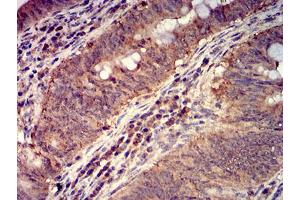 Immunohistochemical analysis of paraffin-embedded rectum cancer tissues using FOLR1 mouse mAb with DAB staining.
