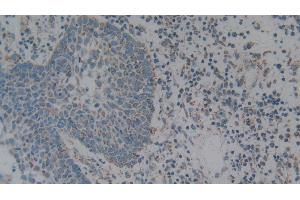 Detection of C1QBP in Human Skin cancer Tissue using Polyclonal Antibody to Complement component 1 Q subcomponent-binding protein, mitochondrial (C1QBP)