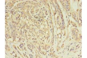 Immunohistochemistry of paraffin-embedded human breast cancer using ABIN7144576 at dilution of 1:100 (ARFIP2 anticorps  (AA 20-295))