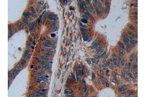 Detection of C2CD3 in Human Colorectal cancer Tissue using Polyclonal Antibody to C2 Calcium Dependent Domain Containing Protein 3 (C2CD3) (C2CD3 anticorps  (AA 1432-1647))
