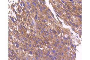 Paraformaldehyde-fixed, paraffin embedded human breast cancer, Antigen retrieval by boiling in sodium citrate buffer (pH6) for 15min, Block endogenous peroxidase by 3% hydrogen peroxide for 30 minutes, Blocking buffer at 37°C for 20min, Antibody incubation with ARF1 (1D4) Monoclonal Antibody  at 1:50 overnight at 4°C, followed by a conjugated secondary and DAB staining. (ARF1 anticorps)