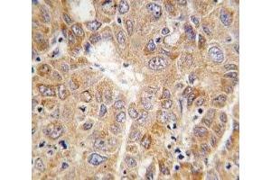 IHC analysis of FFPE human hepatocarcinoma tissue stained with PGK1 antibody