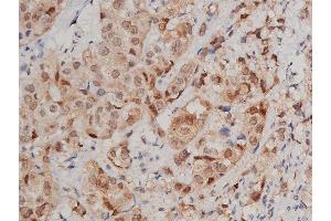 ABIN6269240 at 1/200 staining human breast cancer tissue sections by IHC-P.