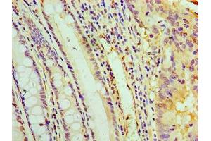 Immunohistochemistry of paraffin-embedded human colon cancer using ABIN7166888 at dilution of 1:100 (PYCR1 anticorps  (AA 2-319))