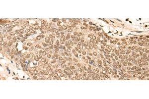 Immunohistochemistry of paraffin-embedded Human esophagus cancer tissue using EIF4A3 Polyclonal Antibody at dilution of 1:45(x200)