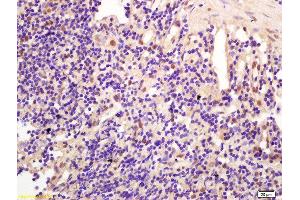 Formalin-fixed and paraffin embedded human gastric carcinoma labeled with Anti-CCDC147 Polyclonal Antibody, Unconjugated  at 1:200 followed by conjugation to the secondary antibody and DAB staining