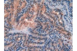 DAB staining on IHC-P; Samples: Human Thyroid cancer Tissue (FZD1 anticorps  (AA 117-322))