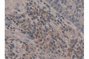 Detection of CASP5 in Human Skin cancer Tissue using Polyclonal Antibody to Caspase 5 (CASP5)