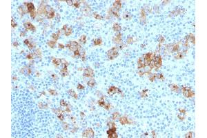 Formalin-fixed, paraffin-embedded human Hodgkin's Lymphoma stained with CD30 Monoclonal Antibody (SPM121). (TNFRSF8 anticorps)