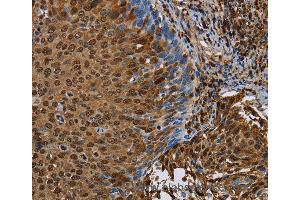 Immunohistochemistry of Human cervical cancer using NRP2 Polyclonal Antibody at dilution of 1:45 (NRP2 anticorps)