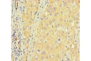 Immunohistochemistry of paraffin-embedded human liver cancer using ABIN7176405 at dilution of 1:100 (ZNF583 anticorps  (AA 1-300))