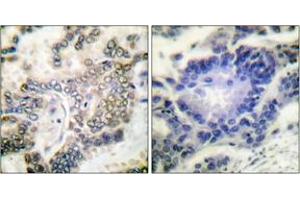 Immunohistochemistry analysis of paraffin-embedded human lung carcinoma tissue, using C/EBP-alpha (Ab-21) Antibody. (CEBPA anticorps  (AA 6-55))