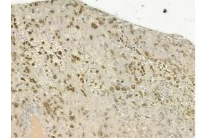 ABIN6265655 and ABIN6277246 at 1/100 staining human melanoma by IHC-P. (TNK2 anticorps  (C-Term))