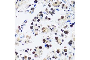 Immunohistochemistry of paraffin-embedded human lung cancer using  antibody (ABIN7265374) at dilution of 1:100 (40x lens).