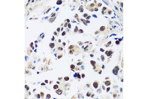 Immunohistochemistry of paraffin-embedded human lung cancer using  antibody (ABIN7265374) at dilution of 1:100 (40x lens). (ASCL4 anticorps  (AA 1-172))