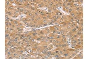 The image on the left is immunohistochemistry of paraffin-embedded Human liver cancer tissue using ABIN7192739(TBC1D21 Antibody) at dilution 1/30, on the right is treated with synthetic peptide. (TBC1D21 anticorps)