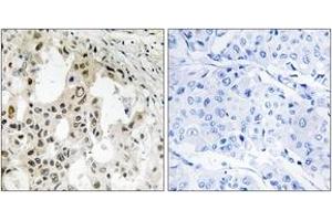 Immunohistochemistry analysis of paraffin-embedded human breast carcinoma tissue, using EIF3D Antibody. (EIF3D anticorps  (AA 101-150))