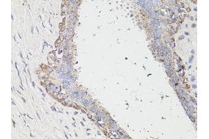 Immunohistochemistry of paraffin-embedded human breast cancer using MAP1LC3B antibody (ABIN6291774) at dilution of 1:100 (40x lens). (LC3B anticorps)